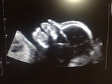 4D ultrazvuk